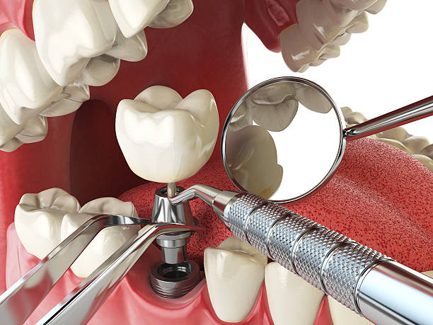 Teeth Whitening in LA